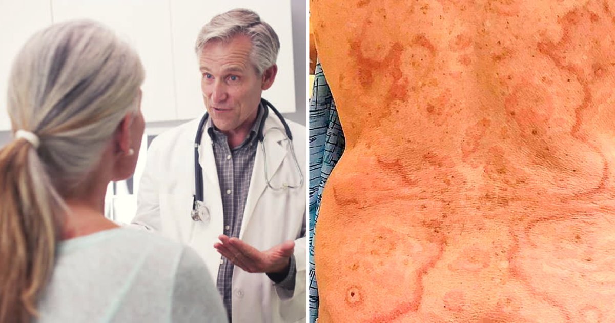 anal2.png?resize=412,275 - Woman Developed Swirly Patches That Turned Out To Be A Sign Of Cancer