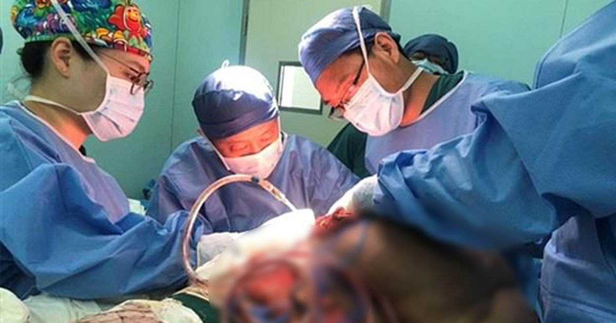 doctors removed mans 61lb cancerous tumour that engulfed his back in 33 hour operation.jpg?resize=1200,630 - Les médecins ont retiré une tumeur cancéreuse de 28 kg d'un homme qui était sur son dos depuis plus de 30 ans.