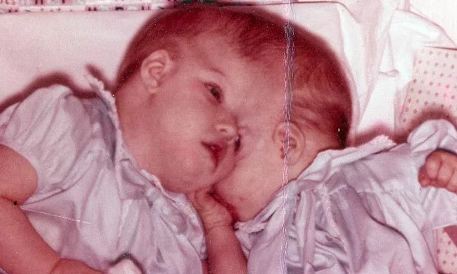 双生児 結合 脳と感覚を共有する、美少女結合双生児