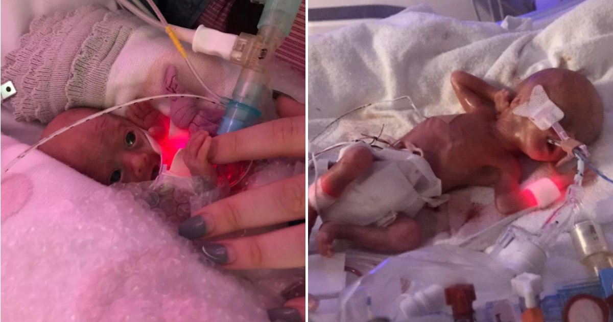 isabella7.png?resize=412,275 - Tiny Baby Who Weighed The Same As 12oz Coke Was Given Only 5 Percent Chance Of Survival