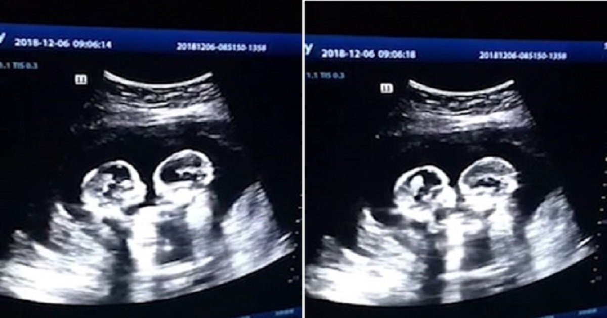 t4.jpg?resize=1200,630 - Routine Ultrasound Scan Revealed Identical Twin Sisters "Fighting" In Their Mother's Womb