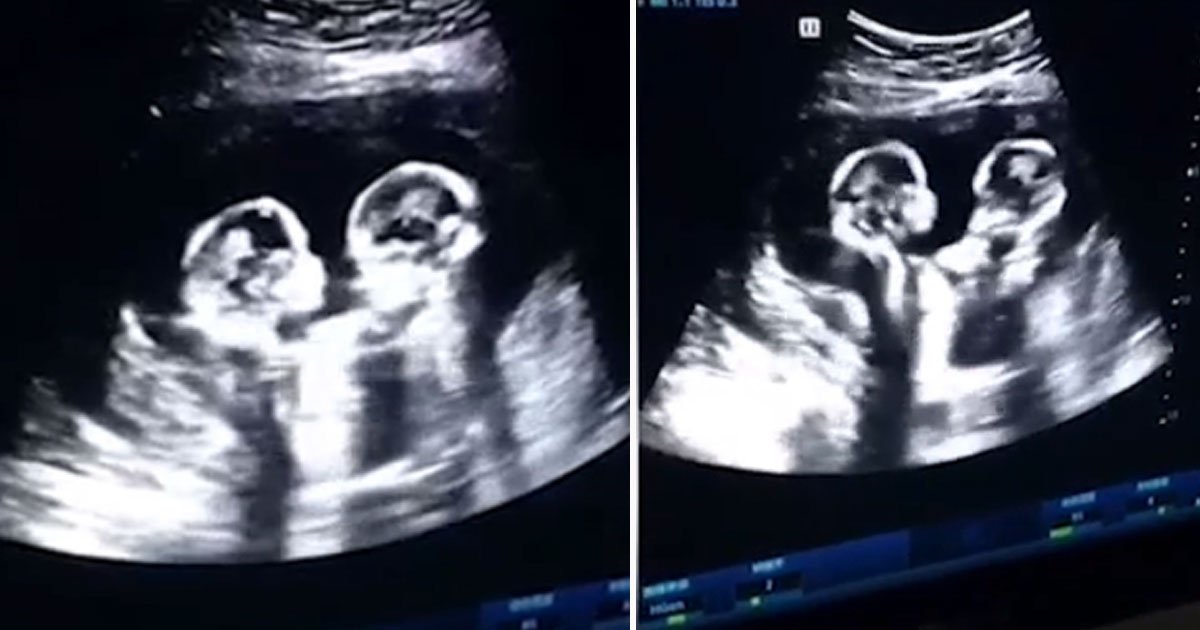 twins fight ultrasound.jpg?resize=412,232 - Video Of Twins Fighting Inside Their Mother's Womb During An Ultrasound Scan