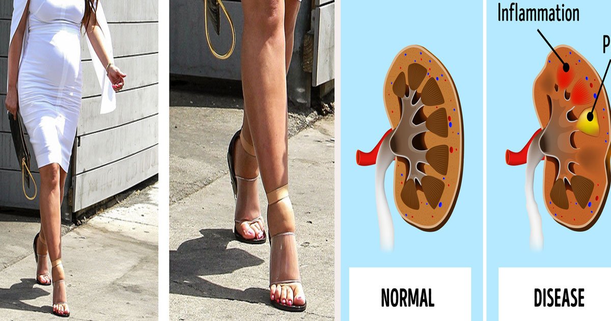 untitled 1 20.jpg?fit=1024%2C538&ssl=1&strip=all - 6 Reasons Why Your Feet Are Swollen