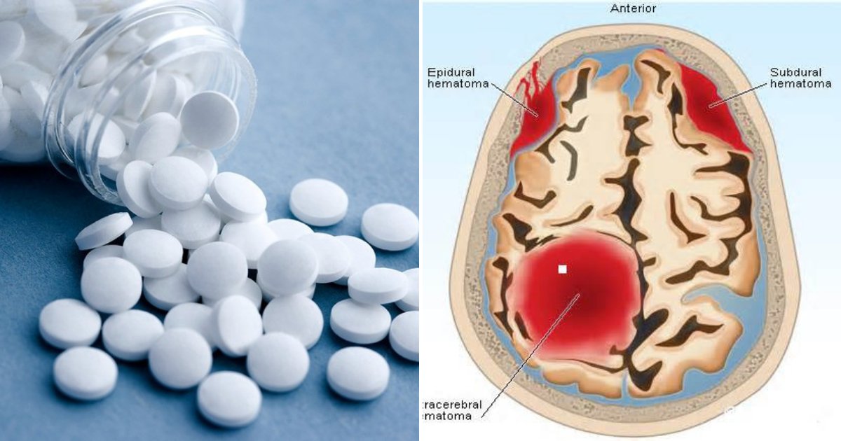 aspirin4.png?resize=1200,630 - Taking ASPIRIN Increases Risk Of Bleeding In The Skull, Especially Among People Without Heart Issues