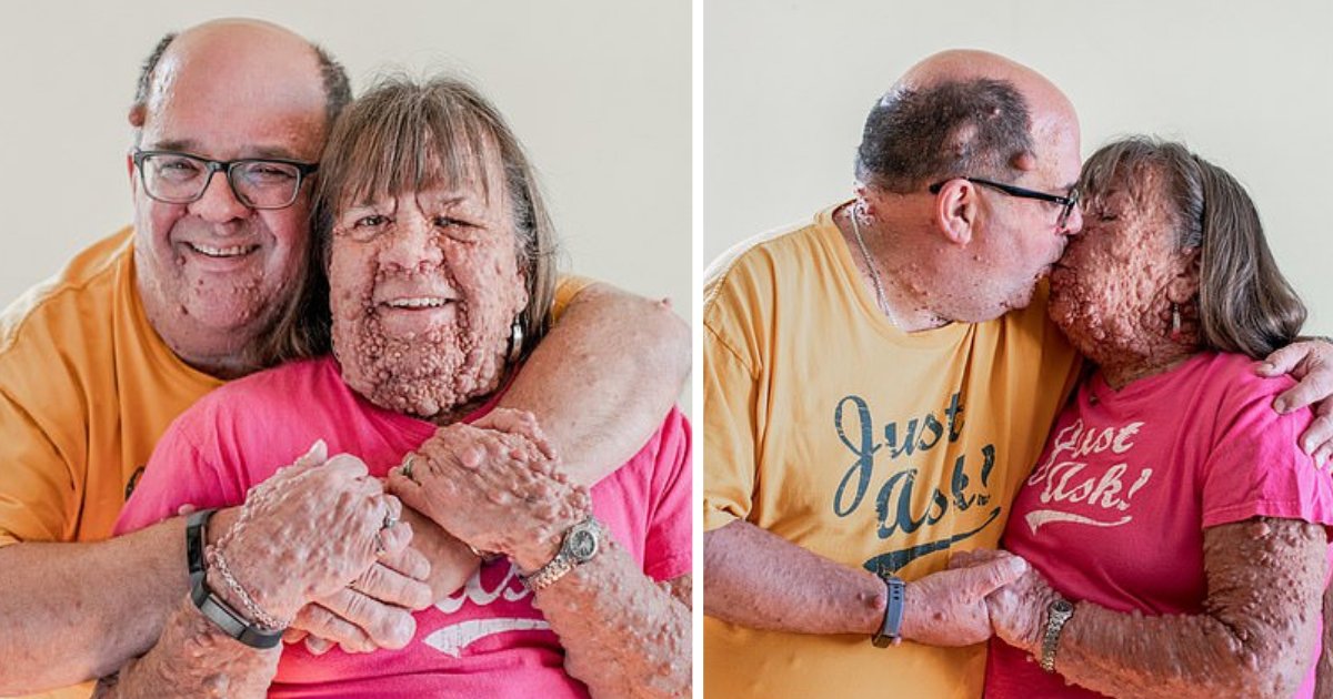 d4 7.png?resize=412,275 - A Couple Bonded Over Their Similar Genetic Disorder