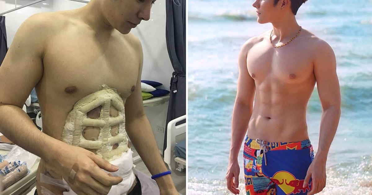featured image 6.png?resize=1200,630 - Un homme thaïlandais a dépensé 3 500 € en chirurgie esthétique pour obtenir de faux abdos.