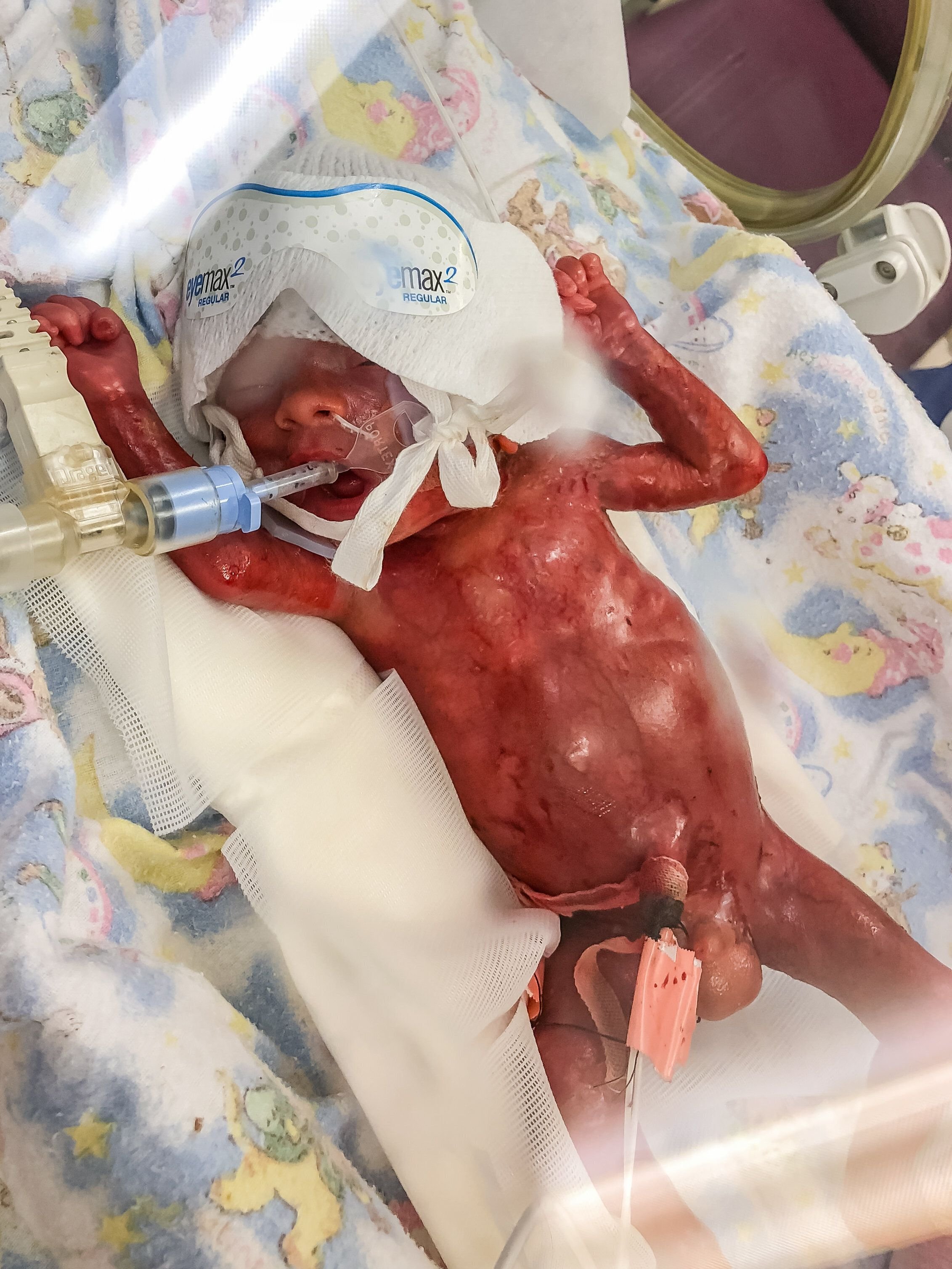 Preemie Baby Miraculously Survives Despite Being Born Without Skin ...
