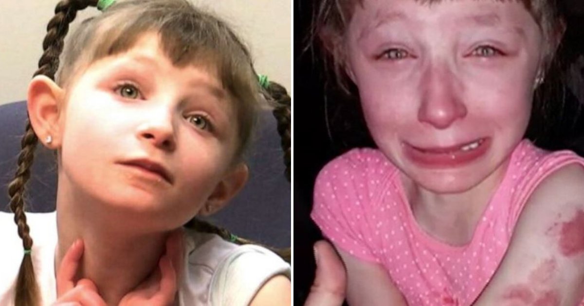 10YearOld Girl Who Cannot Speak Was Left Covered In Bite
