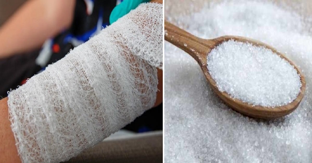 s4.jpg?resize=1200,630 - Voici comment le sucre peut être utilisé pour soigner vos blessures!