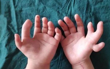 sec 69173537.jpg?resize=1200,630 - Une fillette née avec 14 doigts a finalement subi la chirurgie dont elle avait grand besoin
