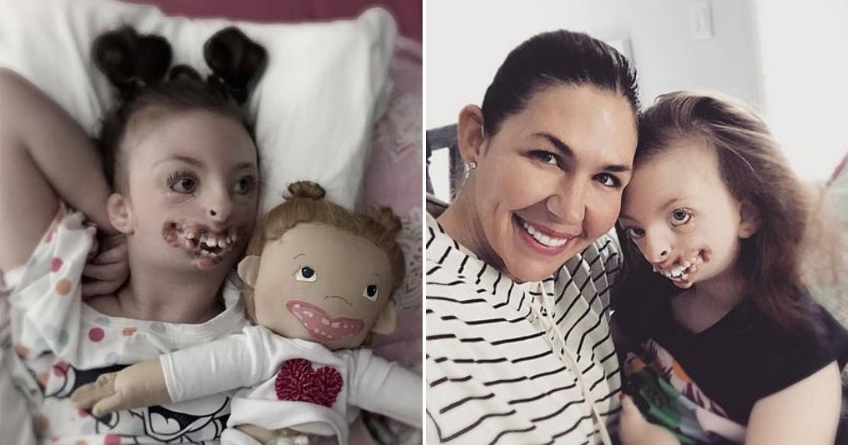 sophia5.png?resize=412,275 - Girl With Facial Deformities And Rare Brain Disorder Passed Away Aged 10