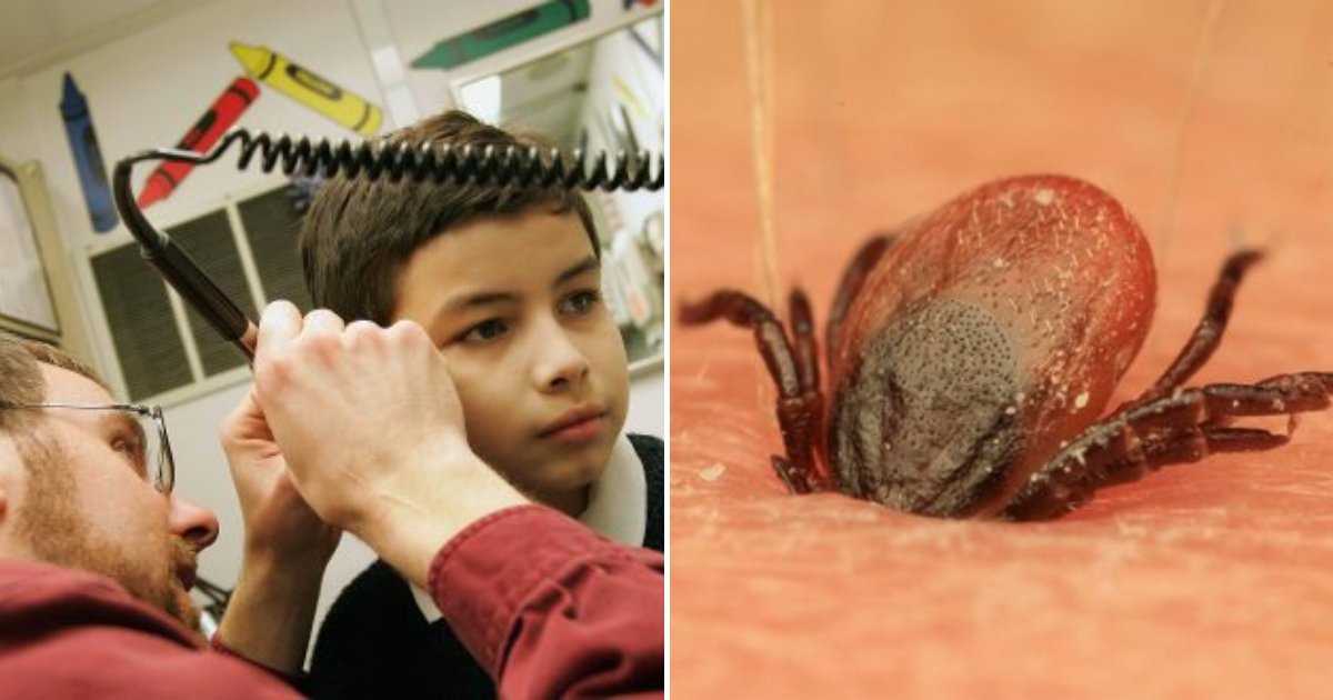 tick4.png?resize=412,275 - 9-Year-Old Boy Keeps Complaining Of Strange Buzzing Inside His Ear. Doctor Found TICK Embedded In His Eardrum!