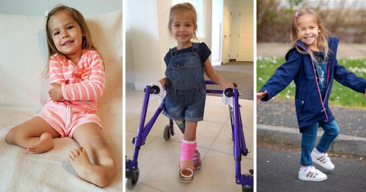 y2 1.png?resize=412,275 - $225K Surgery Helped A Girl Who Was Born With Her Legs Backwards Walk for the First Time