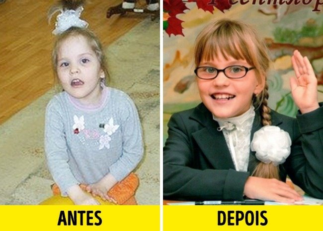 12 Fotos de crianças antes e depois de serem adotadas