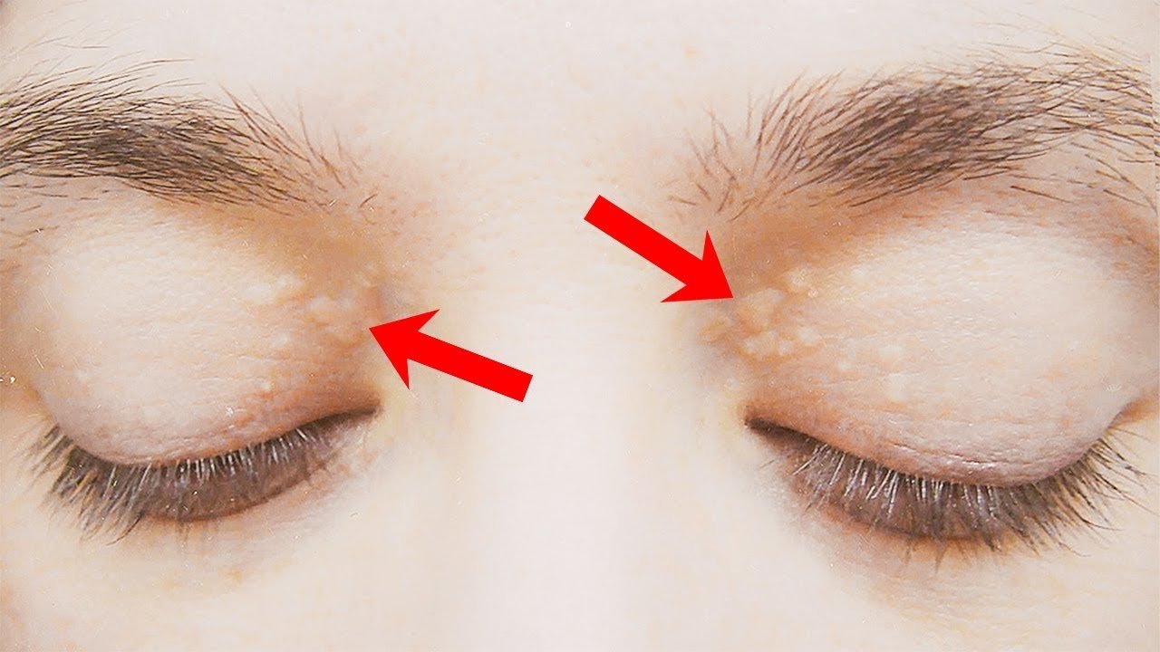 Résultat d'image pour les remèdes à la maison pour les dépôts de cholestérol autour des yeux