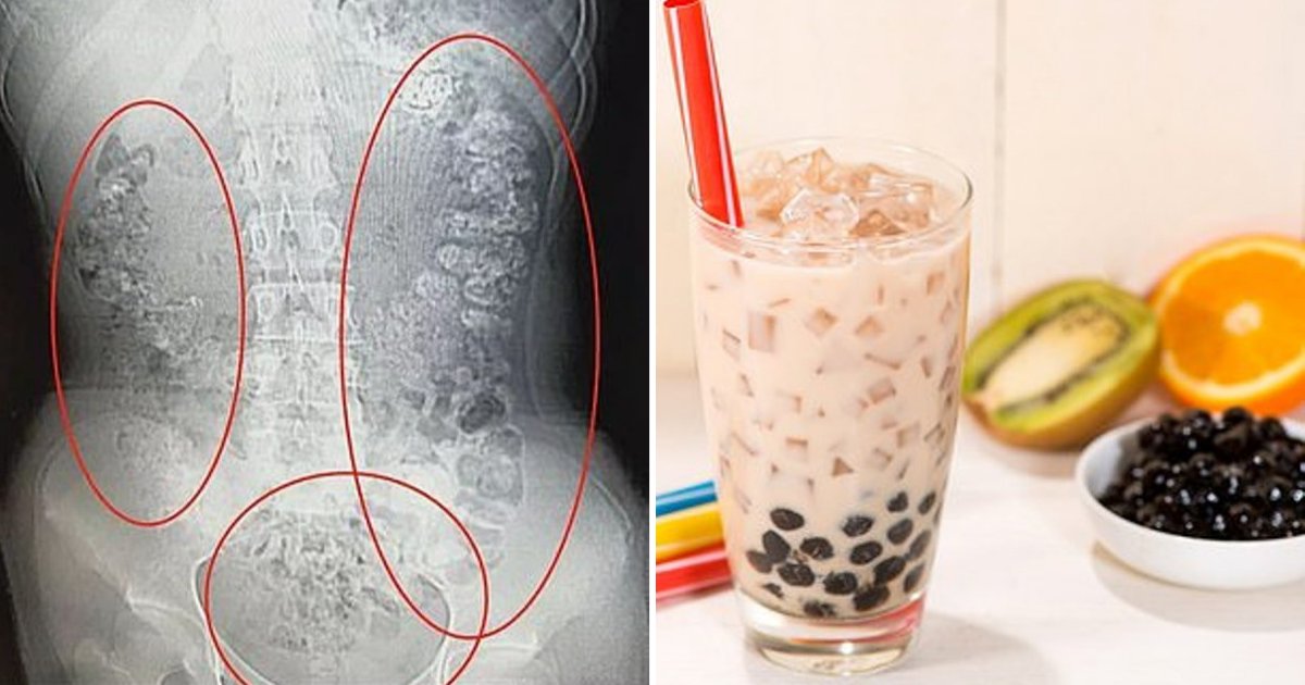 balls.png?resize=1200,630 - 14-Year-Old Girl Who Loves Drinking Milk Tea Discovers She Has Over 100 Tapioca Balls Stuck In Her Body