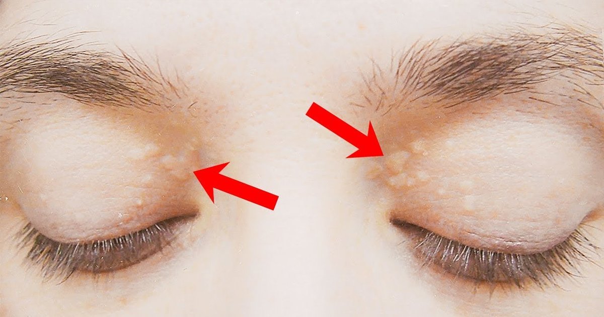 bbbbbbb.jpg?resize=412,275 - How to Get Rid of Cholesterol Deposits Around Your Eyes