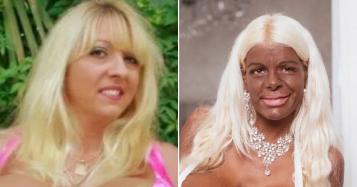 color.png?resize=412,275 - Woman Whose Skin Darkened Dramatically With Experimental Medicine Now Aims For A Different Body Goal