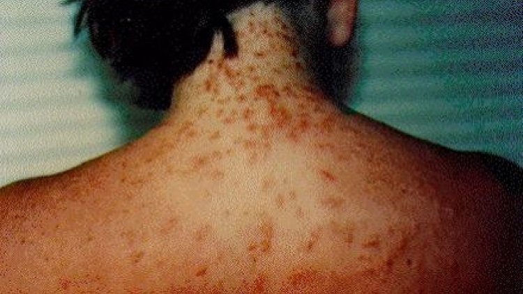 Everything You Need To Know About Sea Lice And How To Avoid Getting