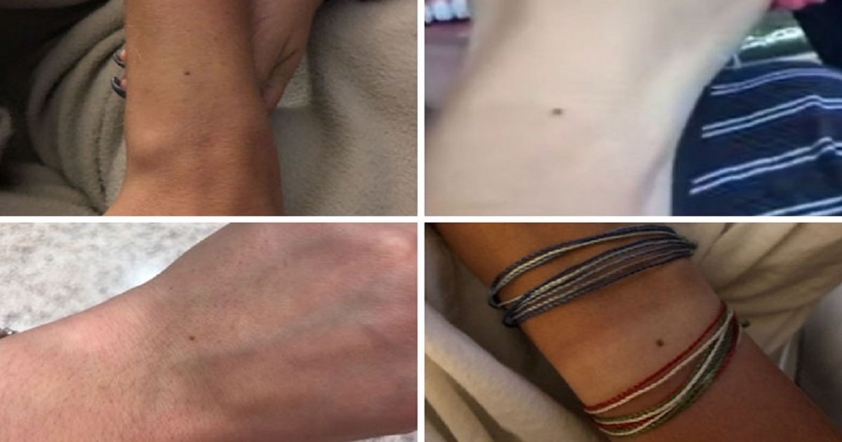 f16.jpg?resize=1200,630 - A Post Claiming All Women Have A Freckle At The Center Of Their Wrist Has Baffled Women To Double-Check Theirs