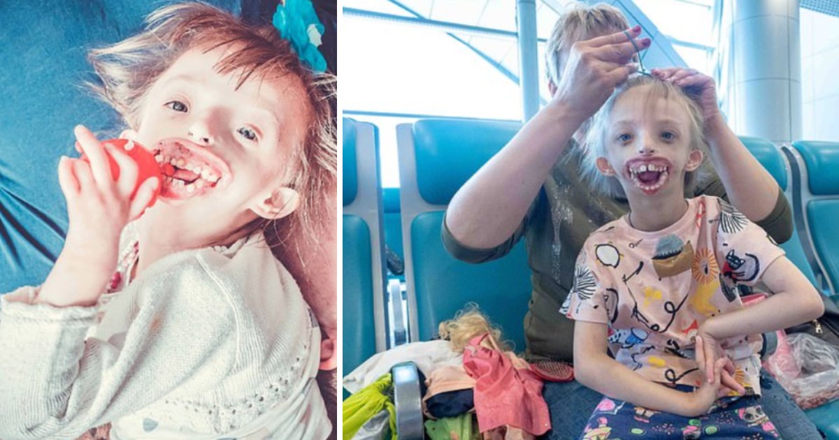 featured image 70.png?resize=412,275 - Russian Girl Born Without Chin And Lips Flew To London For A Life Changing Surgery