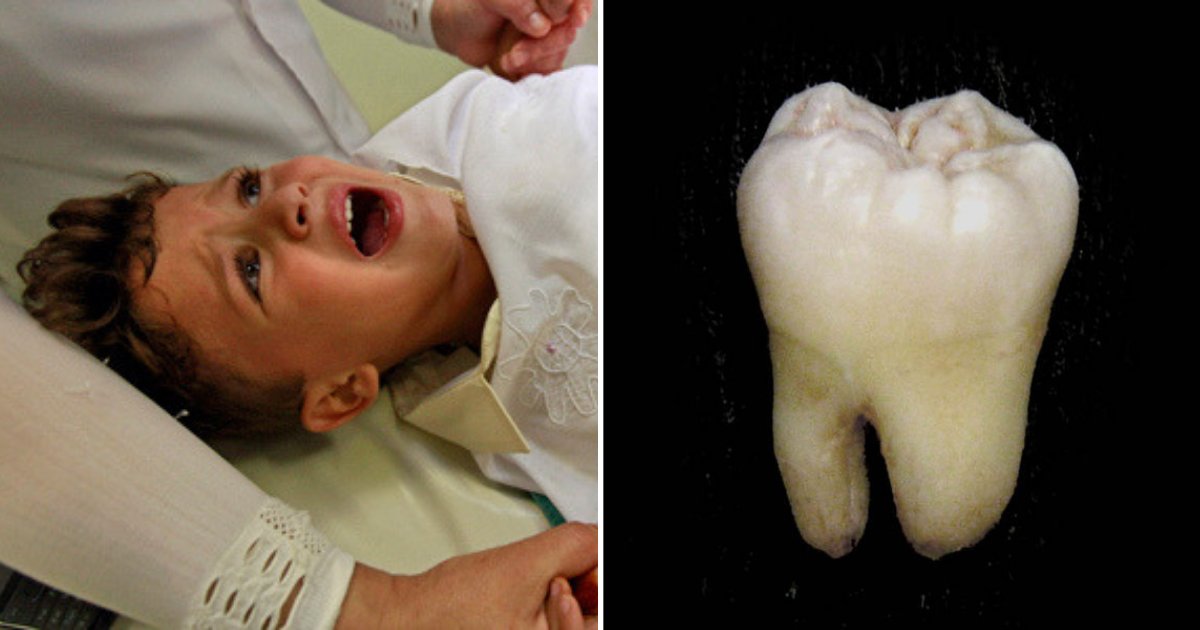 tooth3.png?resize=412,275 - Doctors Were Stunned to Find Boy's Missing Molar Tooth In This Part of His Body