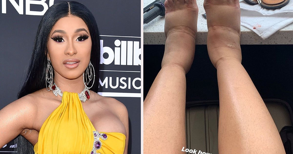 untitled 1 20.jpg?resize=1200,630 - Cardi B Shared Her Swollen Feet As She Recovered From Plastic Surgery