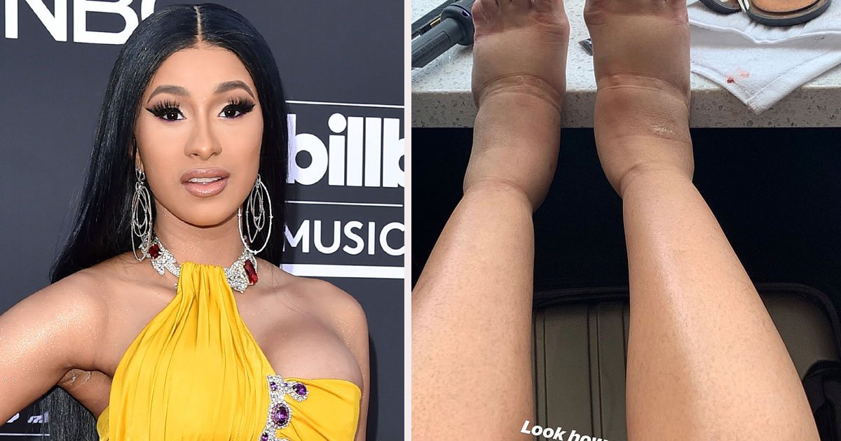 untitled 1 20.jpg?resize=412,275 - Cardi B Shared Her Swollen Feet As She Recovered From Plastic Surgery