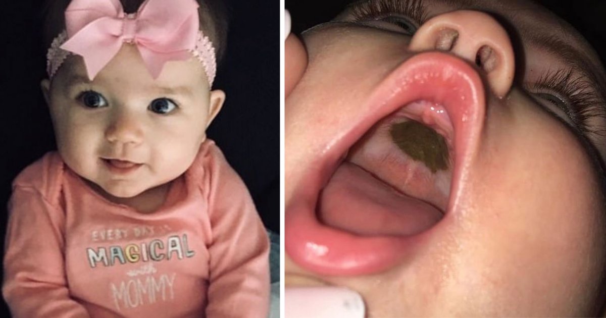 y2 1.png?resize=412,275 - Mom Took Daughter To Doctor After She Saw A Mark Inside The Toddler's Mouth