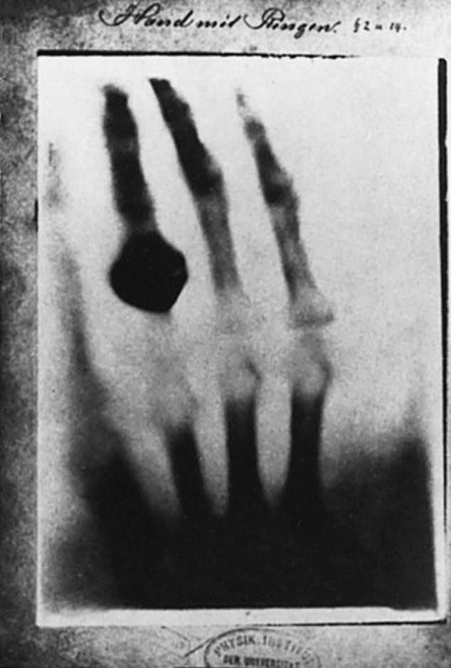 Wilhelm Roentgen unintentionally invented the X-ray and captured the first such image. News of his discovery spread around the world after he published this photo of his wife