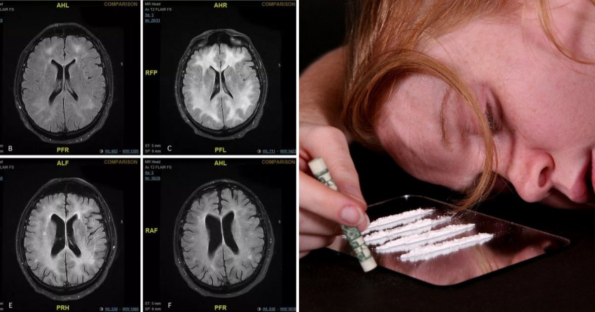 coke4.png?resize=1200,630 - Scans Reveal How Class A Drug Can 'Eat Away' The Brain, Leaving Users With Disabilities