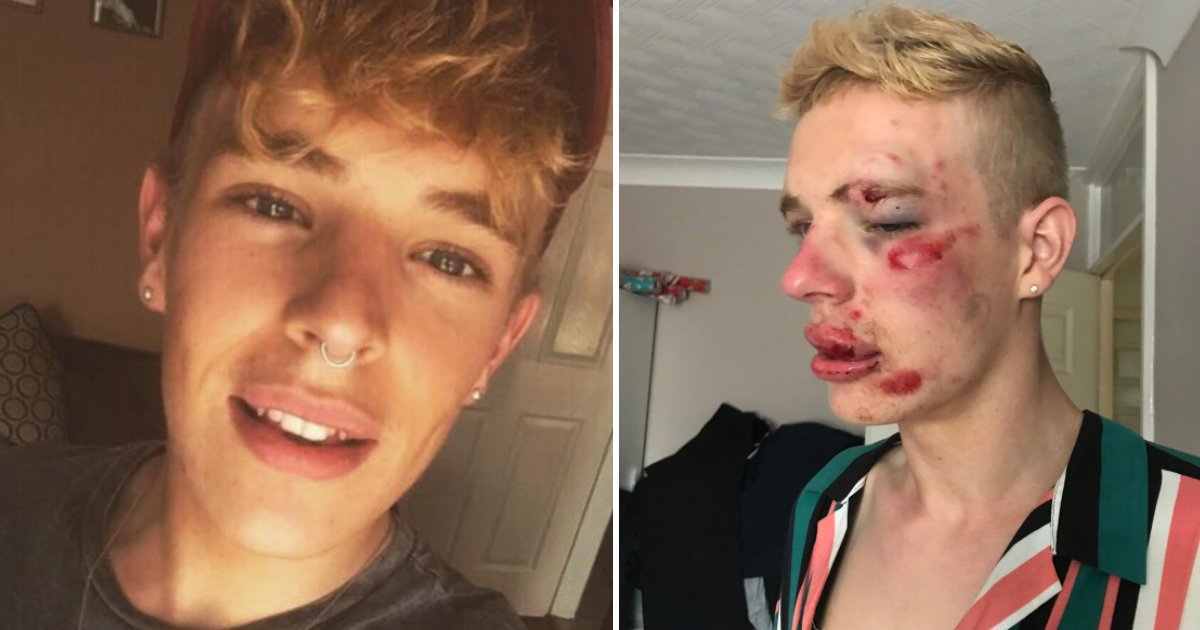 featured image 61.png?resize=412,275 - A 22-Year-Old Barely Survived After Being Beaten By A Gang Of Men In A Homophobic Attack