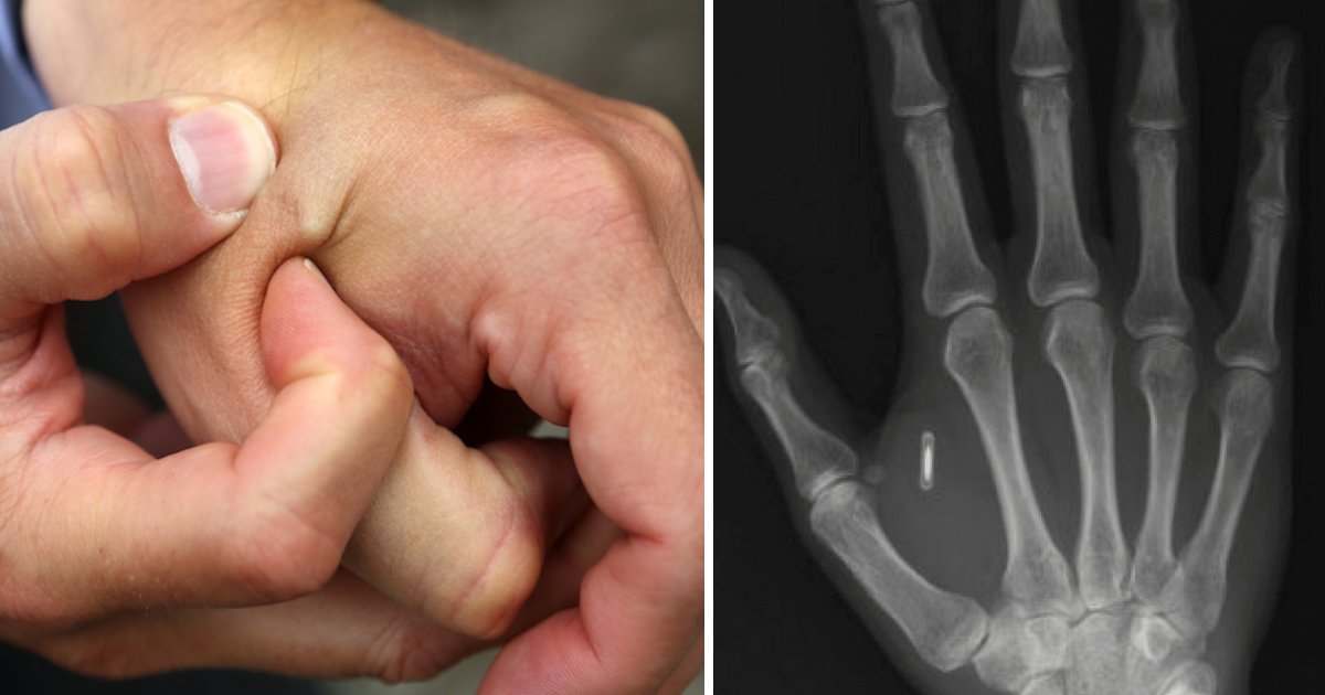 featured image 89.png?fit=1024%2C538&ssl=1&strip=all - People Are Getting Chip Implants In Their Hands To Replace Keys And Wallets In Sweden