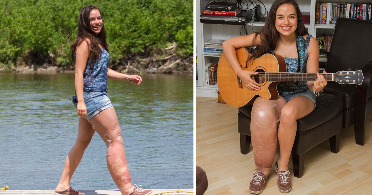 girl with leg swell.jpg?resize=1200,630 - Une fille née avec une maladie génétique qui provoque un gonflement de sa jambe encourage les gens à se sentir bien dans leur peau