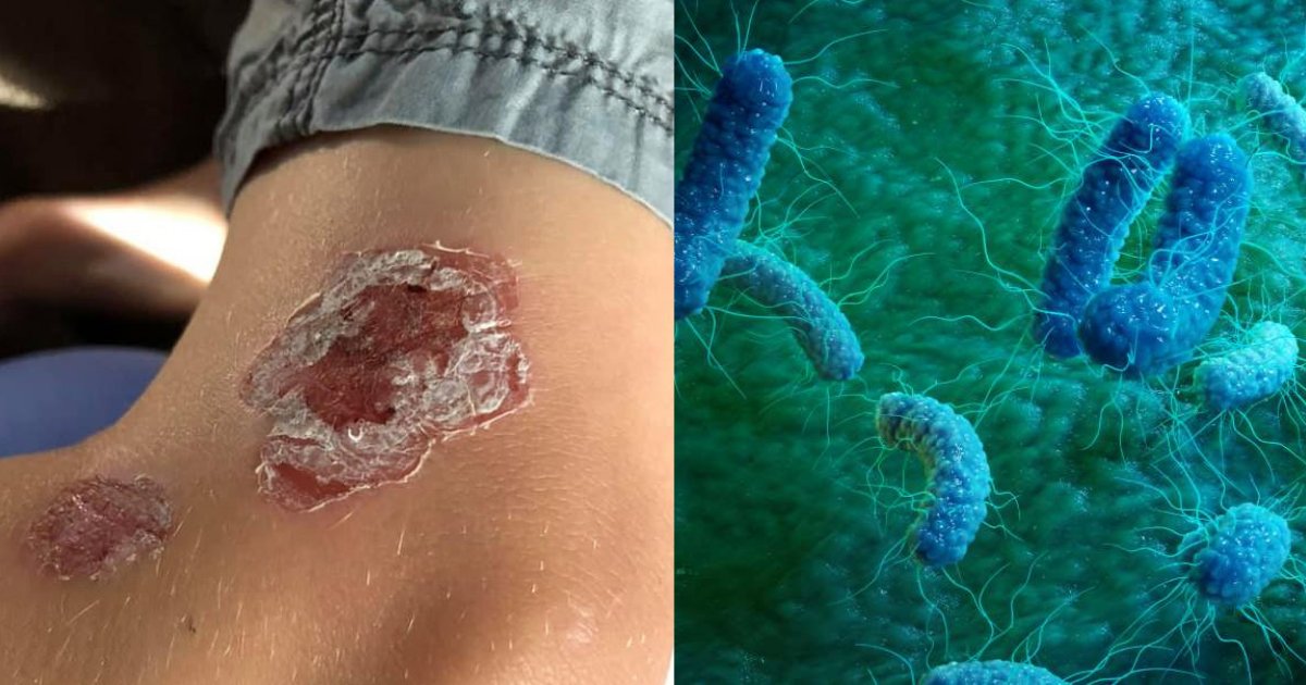 s3 4.png?resize=412,232 - Mom Warns Son to Get Somewhere Fast When He Contacts A Flesh-Eating Bacteria While Swimming In Maryland Beach