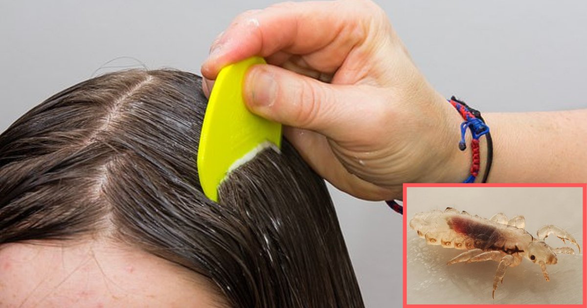 s5 2.png?fit=1024%2C538&ssl=1&strip=all - New Species of Lice Is Alarming Parents Around Australia As They Are Difficult to Treat