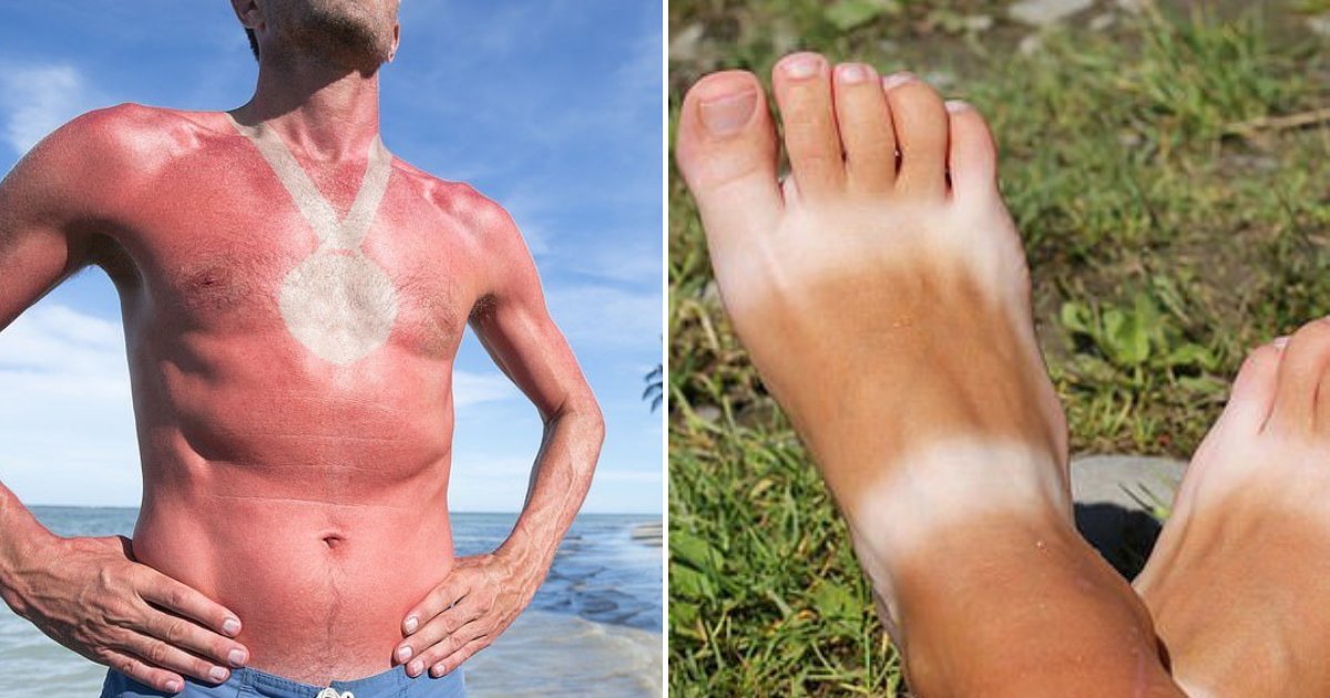 untitled design 43.png?resize=1200,630 - People Are Getting Sunburned On Purpose In New Dangerous Sunburn Tattoo Trend