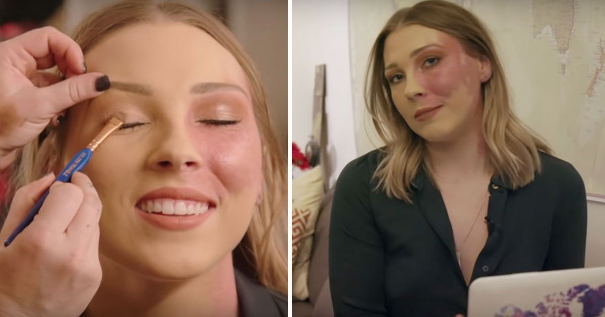 woman bullied birthmark.jpg?resize=412,232 - Woman - Who Was Bullied For Her Birthmark - Is Now Encouraging Others To Accept Their Imperfections