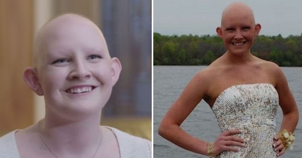 woman refuses wig.jpg?resize=412,275 - Woman With Alopecia Refuses To Wear A Wig As She Feels Insecure With A Wig