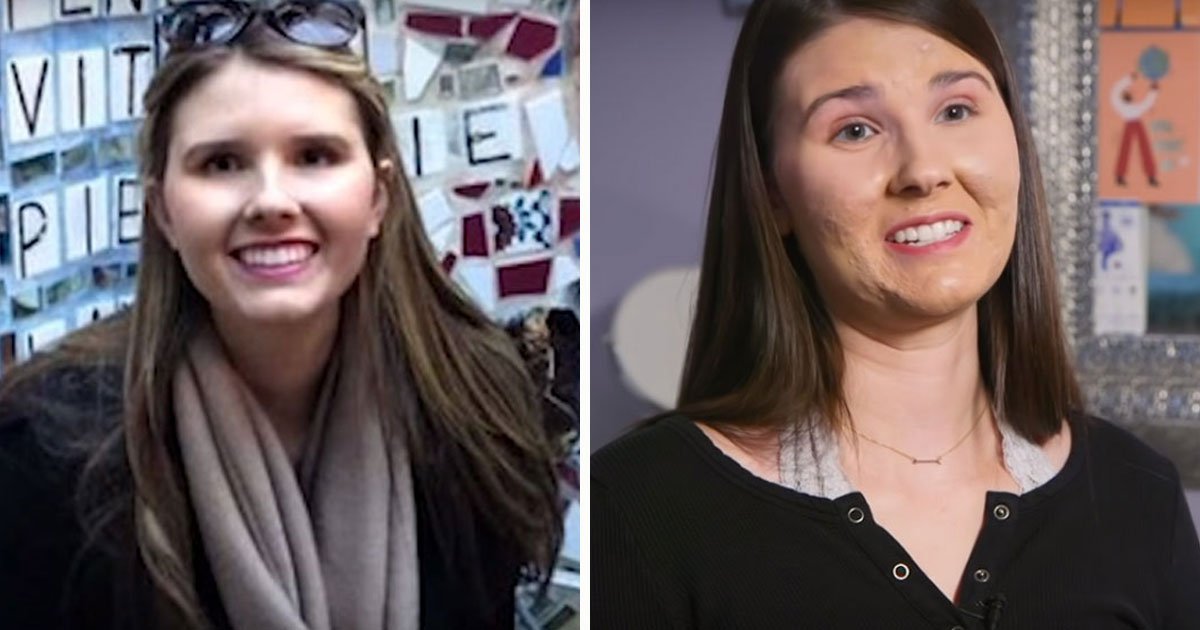 woman with acne.jpg?resize=412,275 - Woman With Severe Cystic Acne Has Finally Shared Her Barefaced Pictures Online To Inspire Others