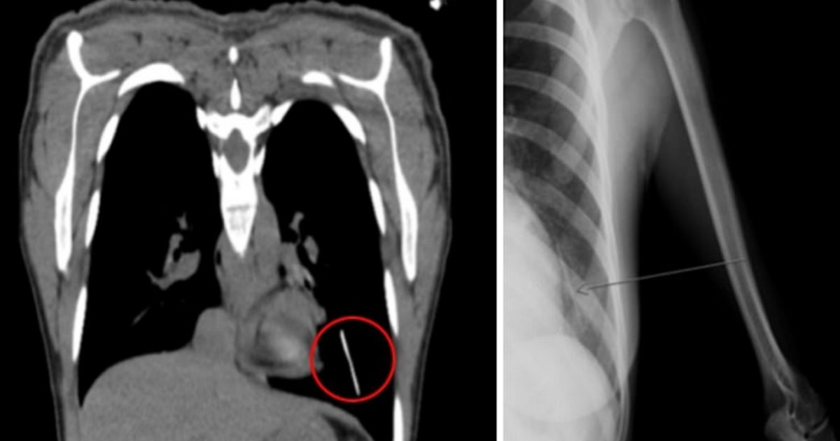 y4 16.png?resize=412,275 - A Woman Was Taken In for Surgery As her Contraceptive Implant Went From Her Arm to Her Lungs