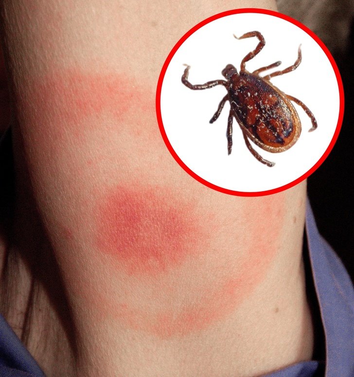 How to Identify a Bug Bite and What to Do With It