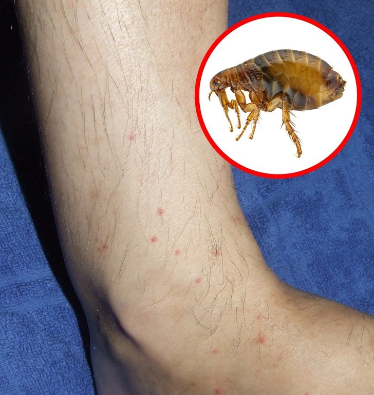 How to Identify a Bug Bite and What to Do With It