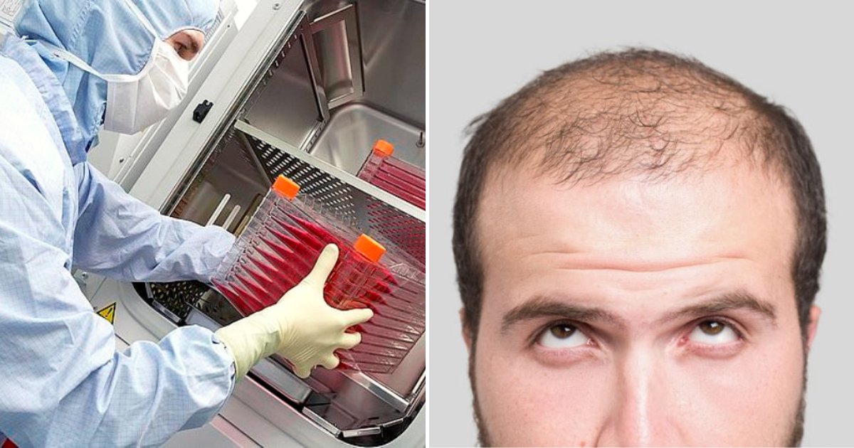 balding2.png?resize=412,232 - New Treatment To Combat Balding Has Been Approved By Authorities