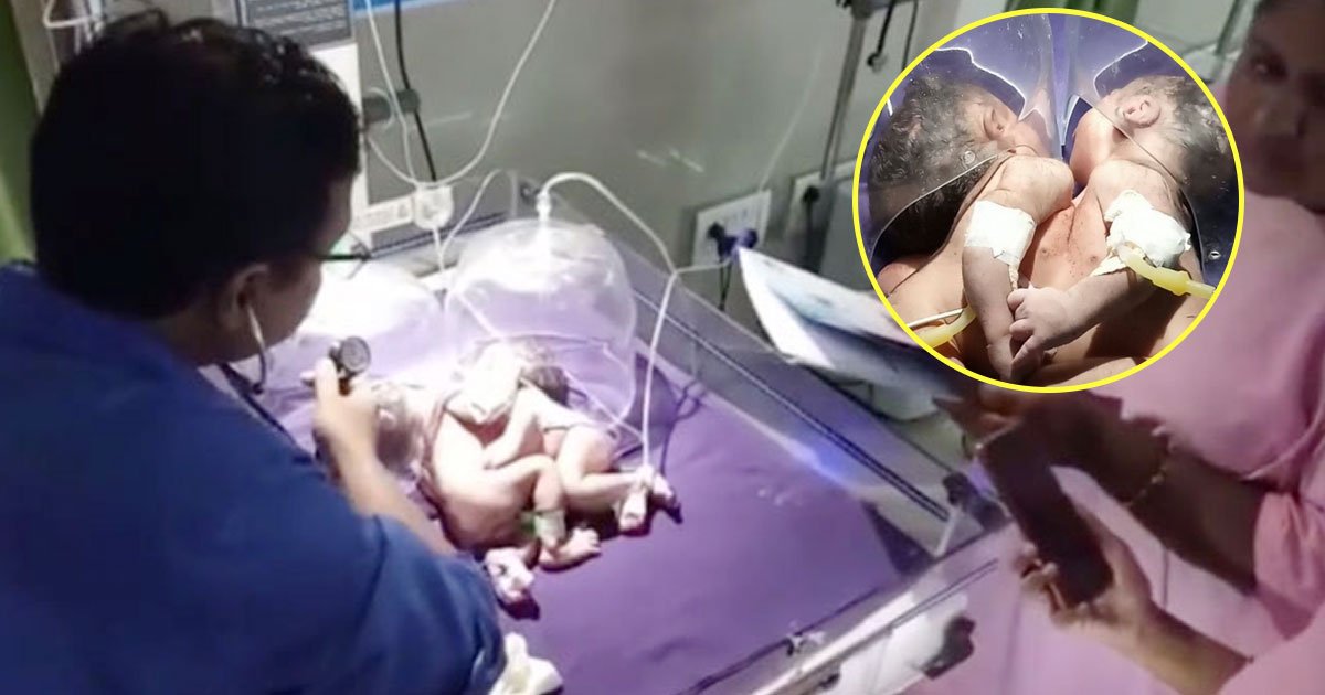 conjoined twins.jpg?resize=412,275 - A Set Of Conjoined Twins Are Born Who Share The Same Heart 