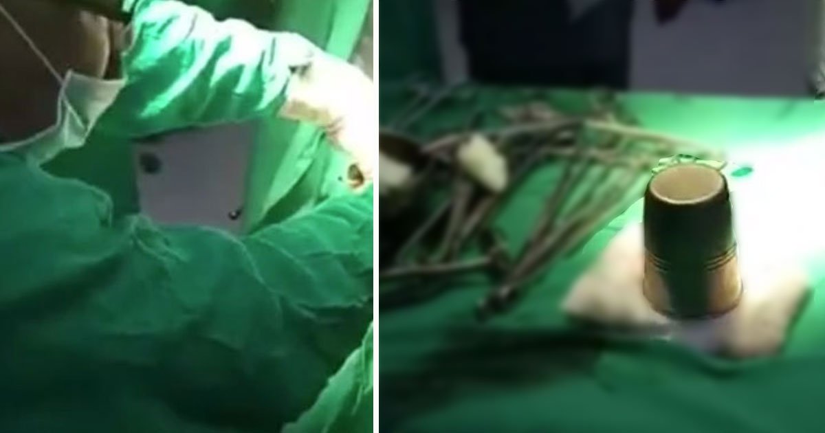 metal cup inside pateint.jpg?resize=412,275 - Doctors Removed An Eight-Inch Metal Cup From A Patient’s Stomach After A “Quack” Doctor Inserted It Into His Bottom