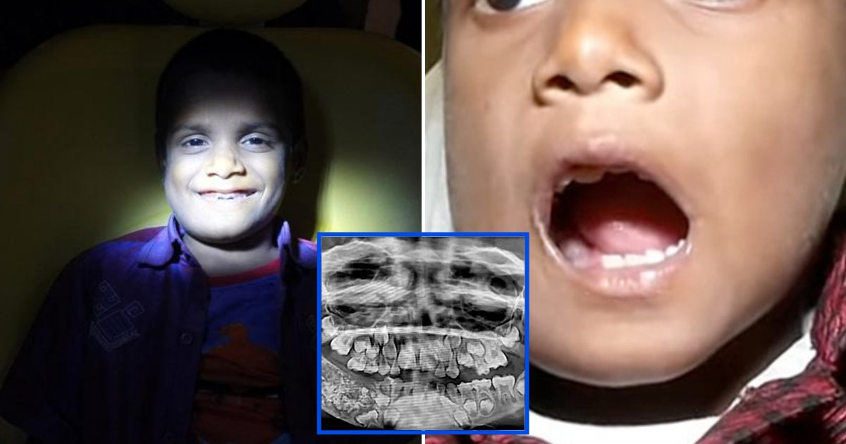 teeth5.png?resize=1200,630 - Un garçon de 7 ans s'est fait enlever plus de 500 dents de la bouche