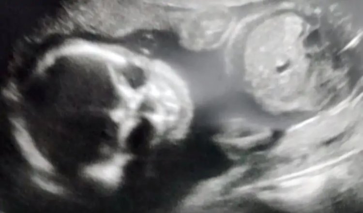 Une Mere Enceinte Panique Quand Son Echographie Montre Un Bebe Squelettique Vonjour