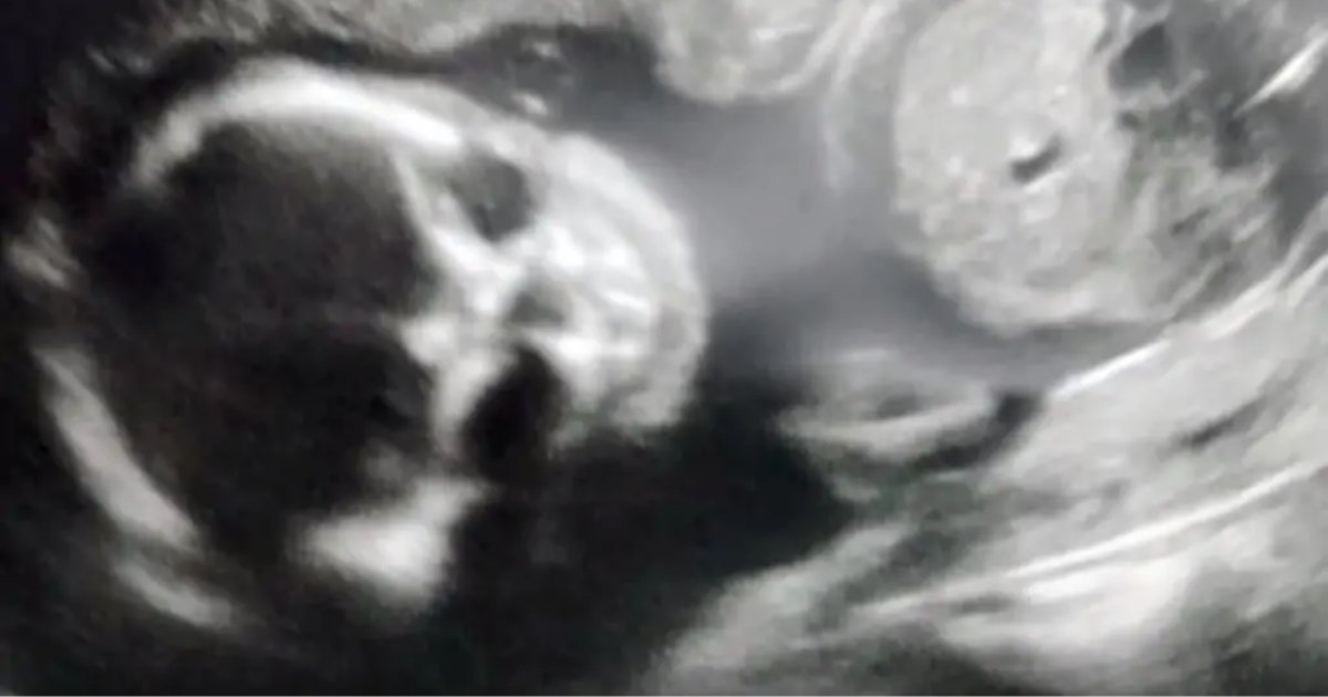 ultrasound4.png?resize=1200,630 - Pregnant Mother Freaked Out When Ultrasound Showed Skeletal Baby
