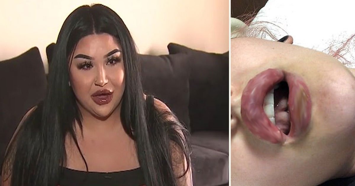 untitled 1 80.jpg?resize=1200,630 - 7 Women Were Left With Infected Lips After Receiving Lip Filler Injections From Someone Who Claimed To Be Licensed
